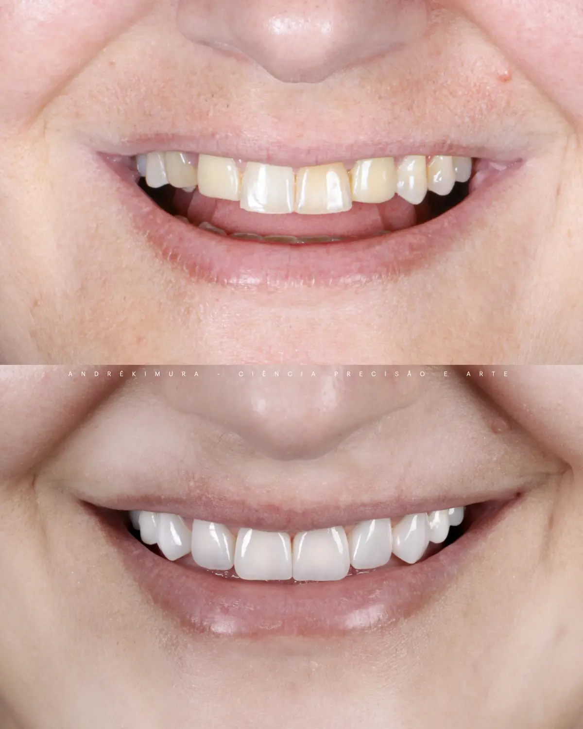 Caso 1 · antes e depois