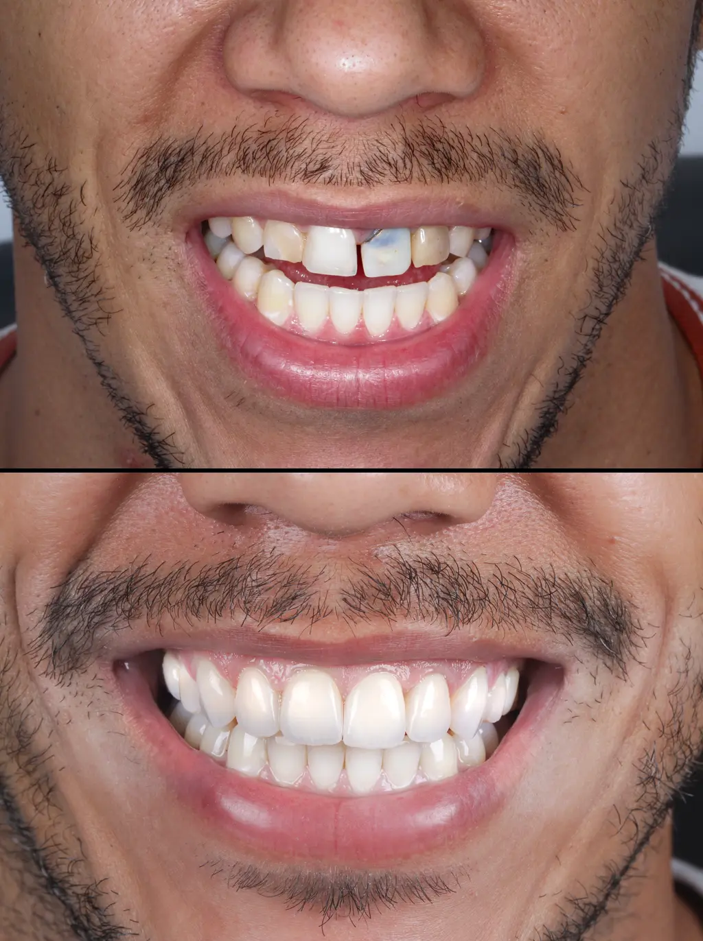 Caso 4 · antes e depois