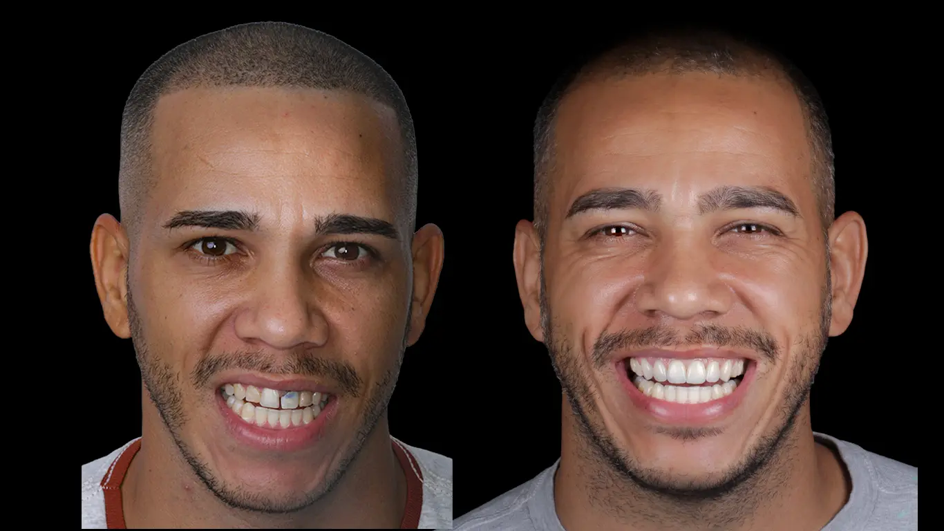 Caso 4 · antes e depois, rosto